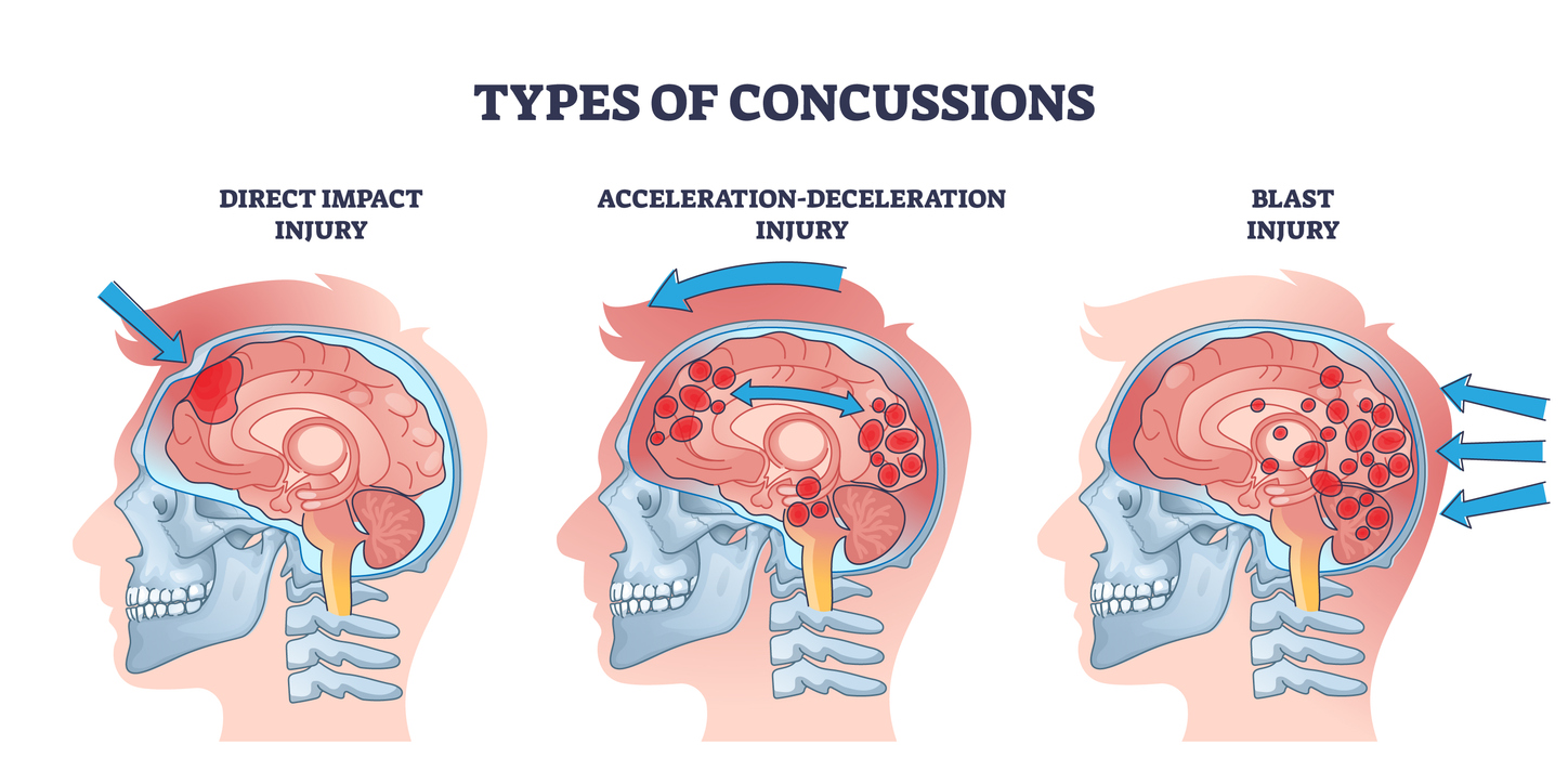 Concussions Symptoms, Causes & Treatments   Guadalupe Regional ...